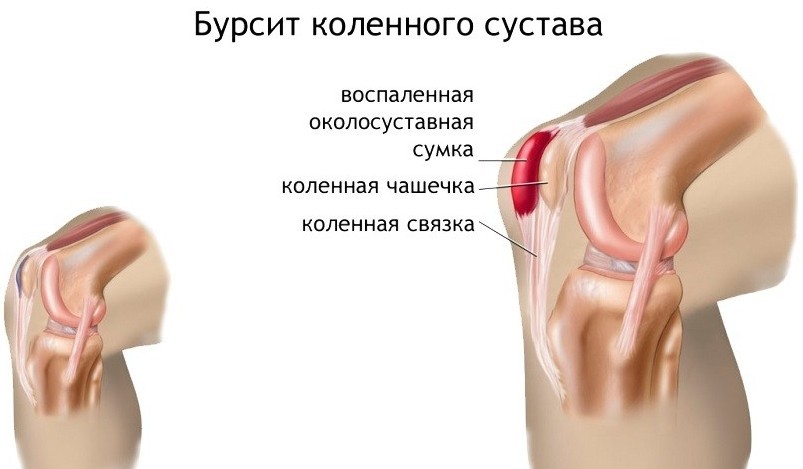 Как лечить препателлярный бурсит коленного сустава