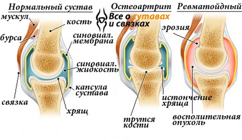 Как лечить синовит тазобедренного сустава