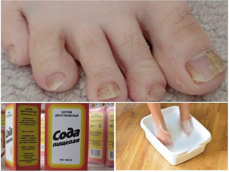 Лечение грибка ногтей пищевой содой