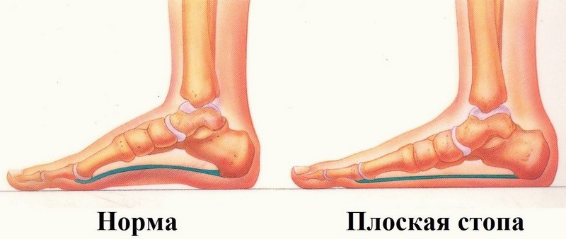 Как выбрать ортопедические стельки при плоскостопии