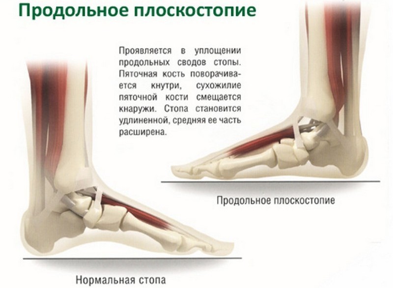 Как выбрать ортопедические стельки при плоскостопии