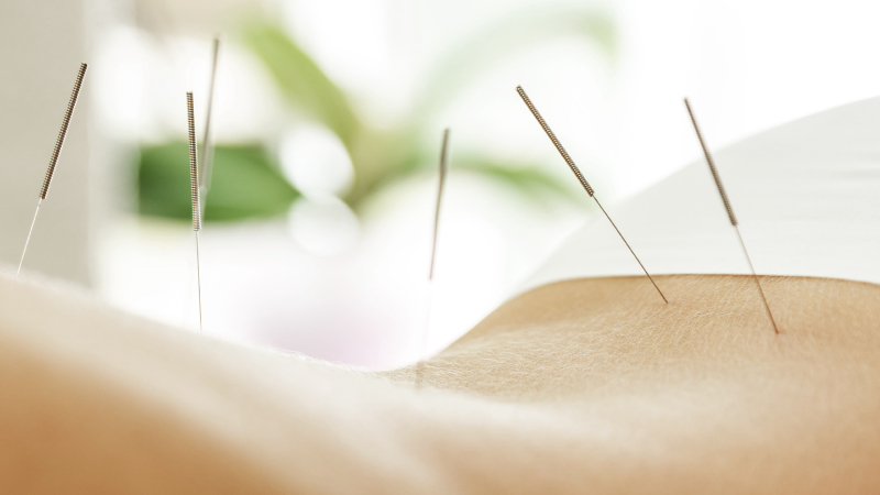 Стоит ли пробовать иглоукалывание для похудения: отзывы об эффективности