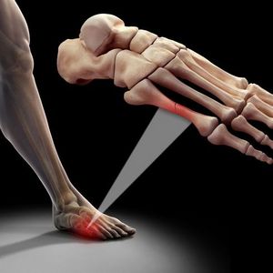 Как проходит реабилитация после перелома плюсневой кости стопы