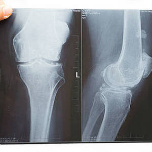 Строение коленного сустава человека