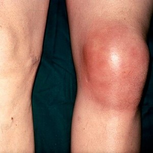 Что такое супрапателлярный бурсит коленного сустава и как его лечить