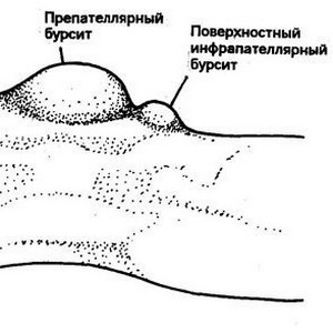 Что такое супрапателлярный бурсит коленного сустава и как его лечить