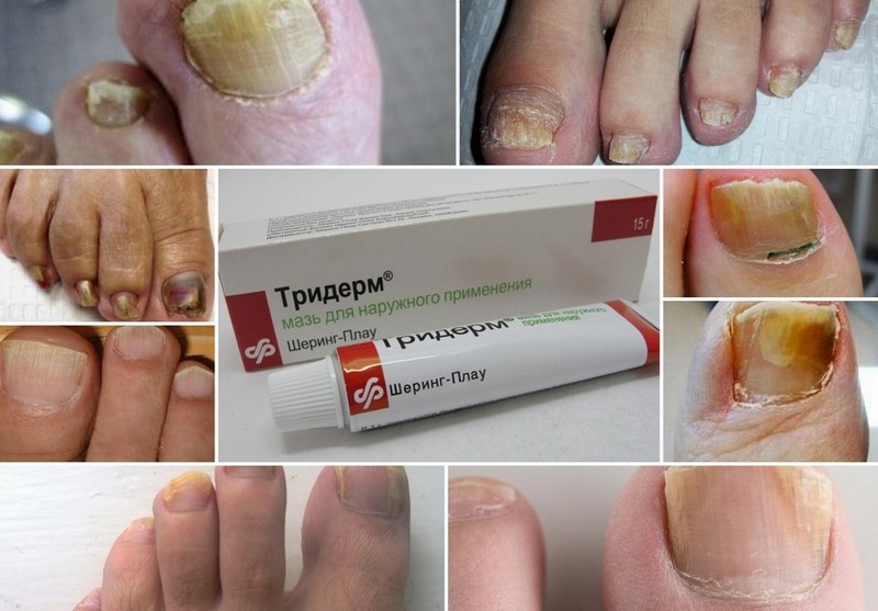 Мазь Тридерм от грибка ногтей: показания к применению