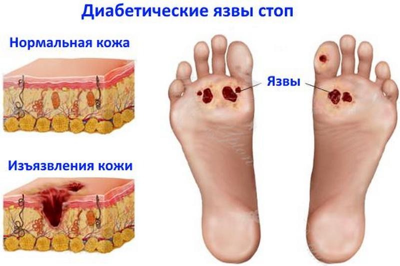 Лечение трофических язв на ногах при сахарном диабете