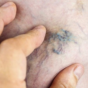 Что такое тромбоз нижних конечностей и как с ним бороться?