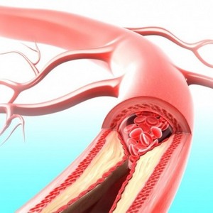 Что такое тромбоз нижних конечностей и как с ним бороться?