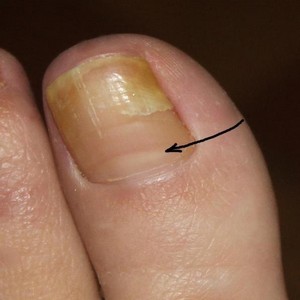 Как удалить ноготь, пораженный грибком - больно ли это?