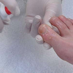 Как удалить ноготь, пораженный грибком - больно ли это?