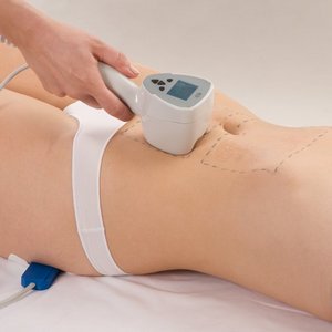 Можно ли убрать растяжки на ногах лазером