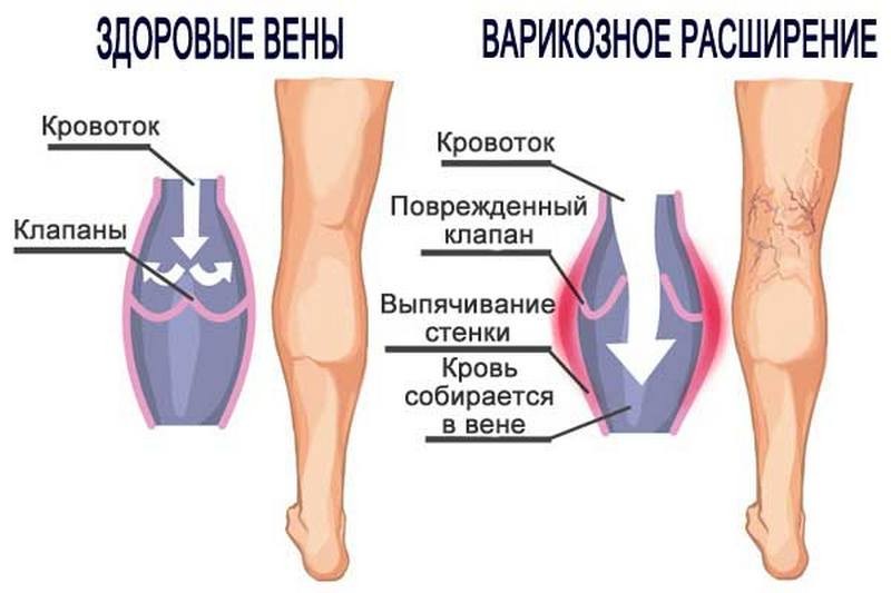 Комплекс упражнений при варикозе нижних конечностей и малого таза
