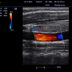 Что такое ультразвуковая допплерография