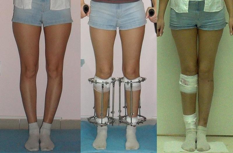 Как лечить вальгусную деформацию коленных суставов и выпрямить ноги