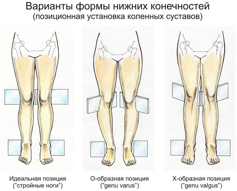Как лечить вальгусную деформацию коленных суставов и выпрямить ноги