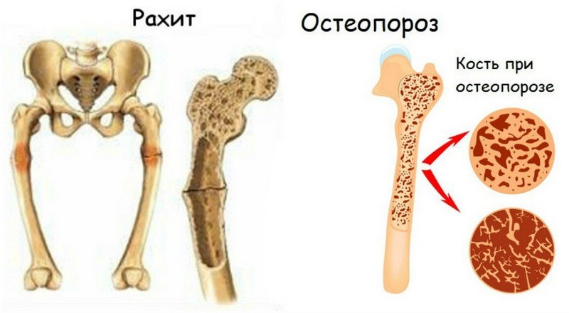 Как лечить вальгусную деформацию коленных суставов и выпрямить ноги