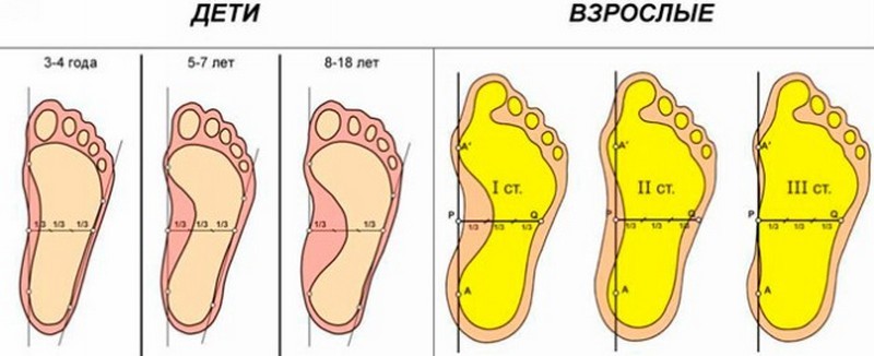 Как лечить вальгусное плоскостопие и откуда оно берется