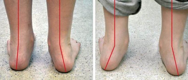 Как лечить вальгусное плоскостопие и откуда оно берется