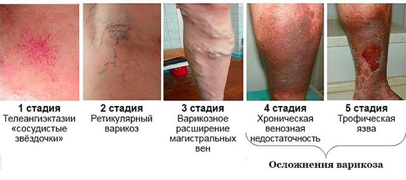 Лечение варикоза простыми способами Неумывакина