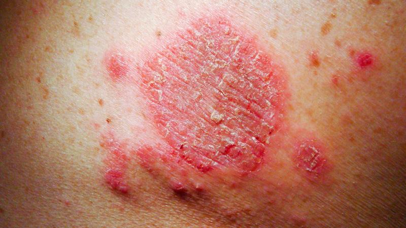 Что такое варикозная экзема и как её лечить