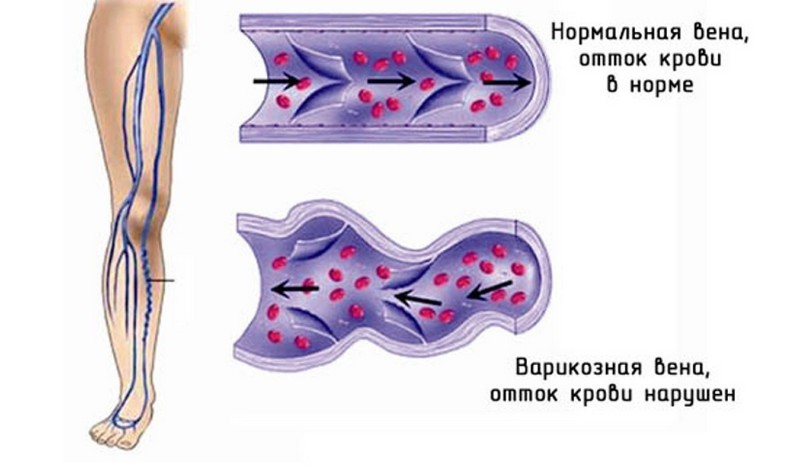Какие витамины пьют при варикозе