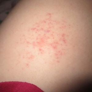 Фотоэпиляция: противопоказания и последствия