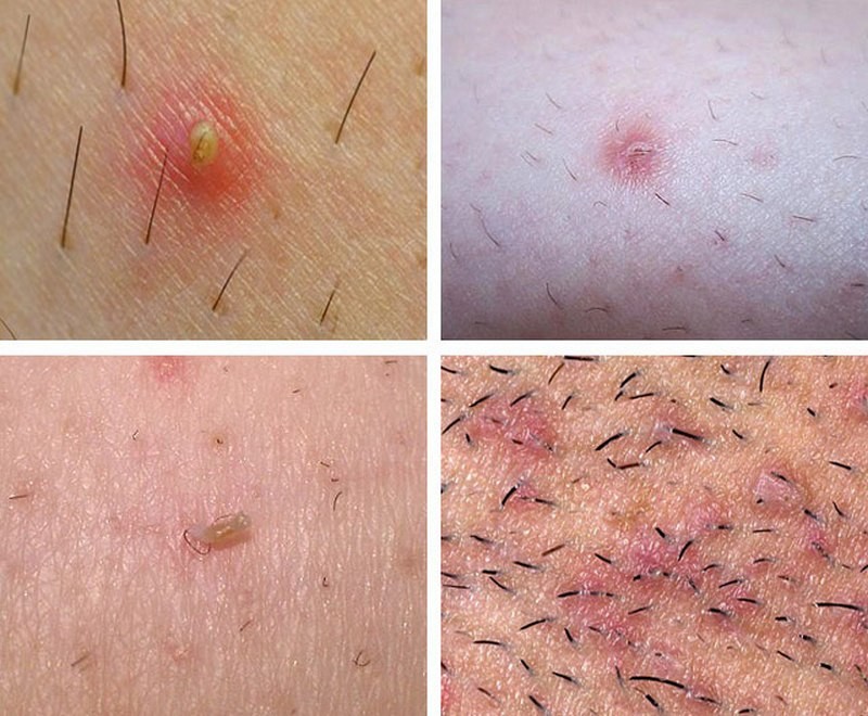 Почему врастают волосы после шугаринга и что делать