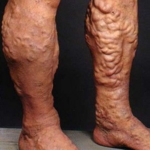 Воспаление вен на ногах: лечение шишек и закупорок вен народными средствами