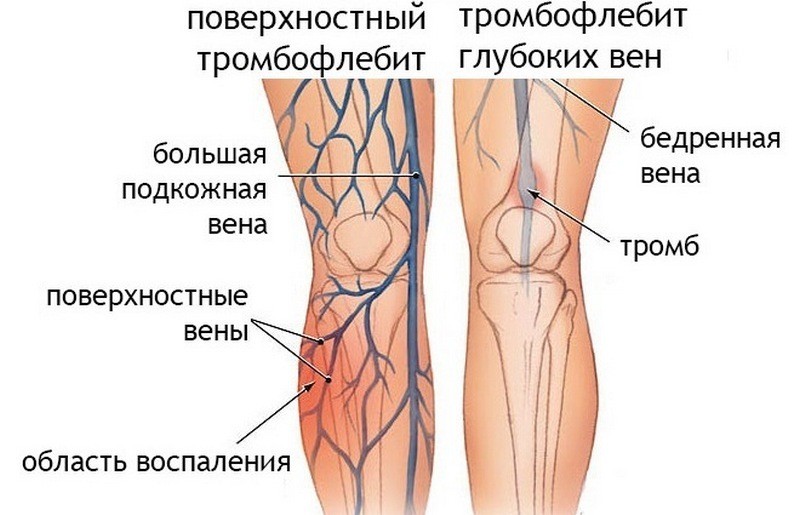 Воспаление вен на ногах: лечение шишек и закупорок вен народными средствами