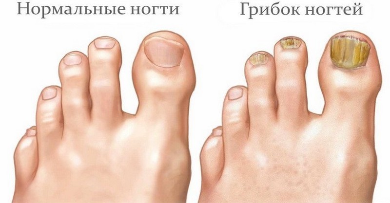 Почему воняет под ногтями на ногах и как убрать запах